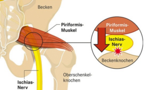 Das Bild zeigt die Lage des Piriformismuskels und seine Anbindung an Hüft- und Oberschenkelknochen sowie die Lage des Ischiasnerves